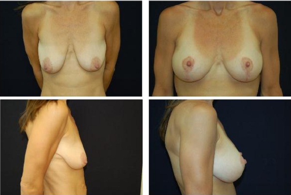 Breast_Augmentation_and_Lift_Case_430