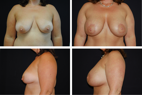 Breast_Augmentation_and_Lift_Case_9448