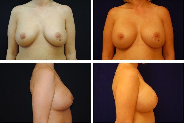 Breast_Implant_Remove_and_Replace_Case_5407