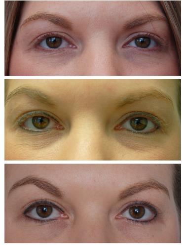 Case 602 - Permanent Eyeliner (Micropigmentation)