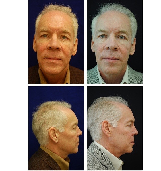 Hair Transplant Case 35601 - The Plastic Surgery Group