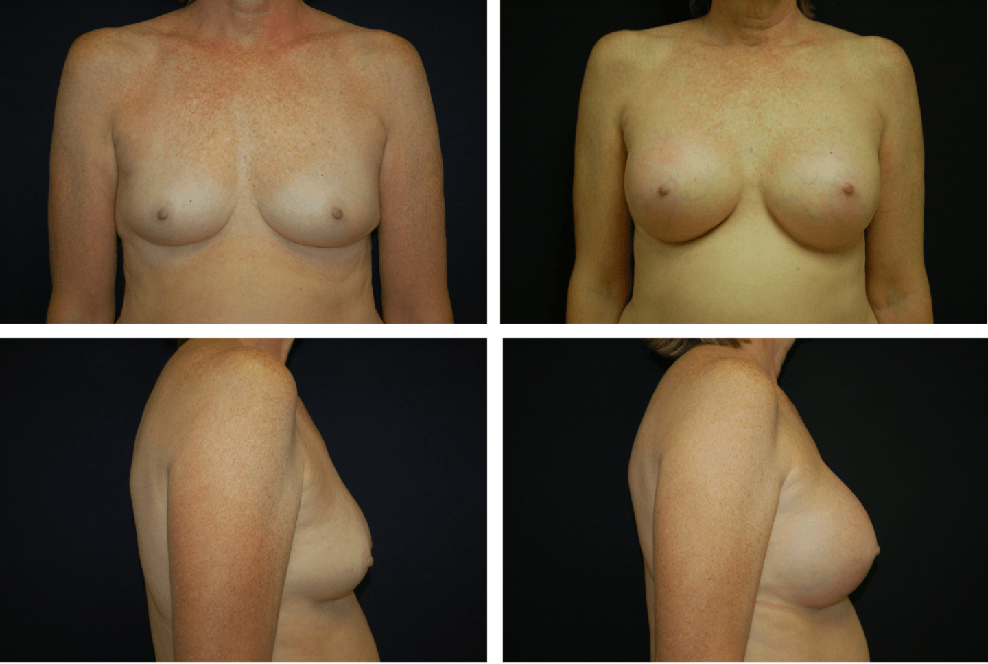 Breast Augmentation Case 99112