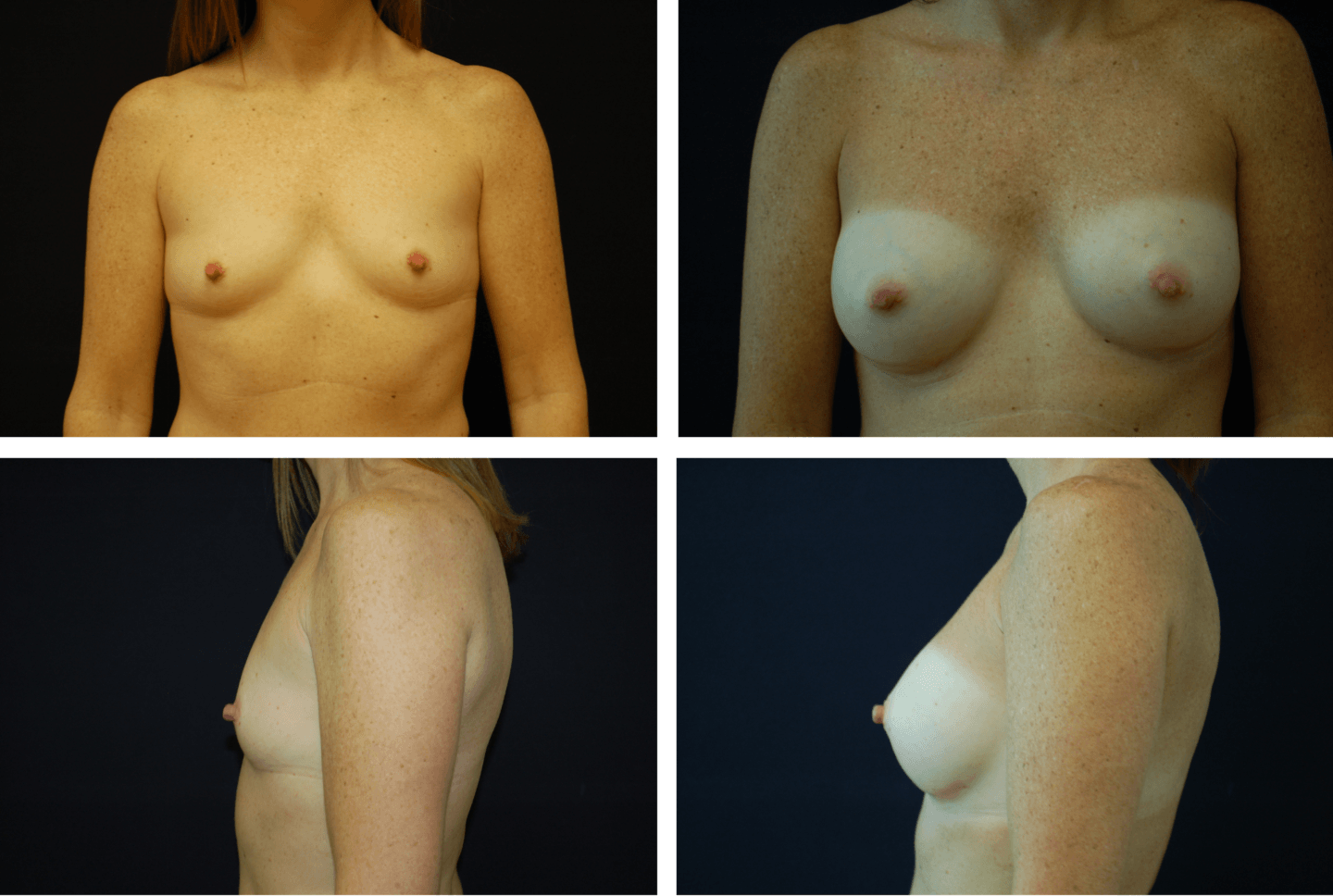 Breast Augmentation Case 99113