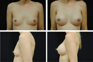 Breast Augmentation Silicone Case 99115