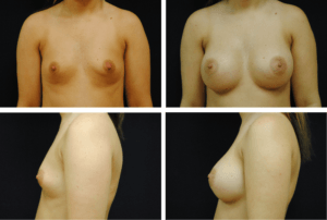 Breast Augmentation Silicone Case 99117