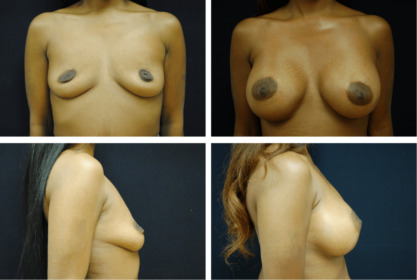 Breast Augmentation Silicone Case 99118