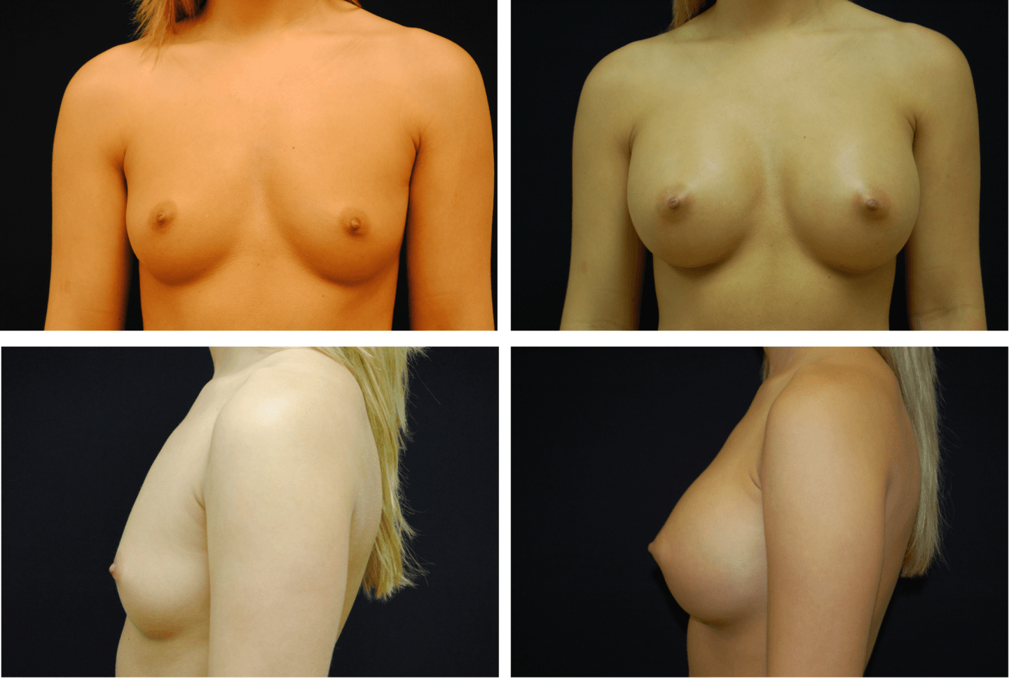 Breast Augmentation Silicone Case 99120