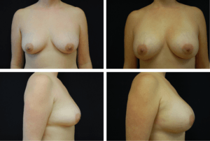 Breast Augmentation Silicone Case 99123