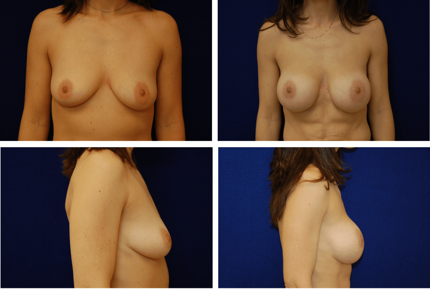 Breast Augmentation Silicone Case 99124