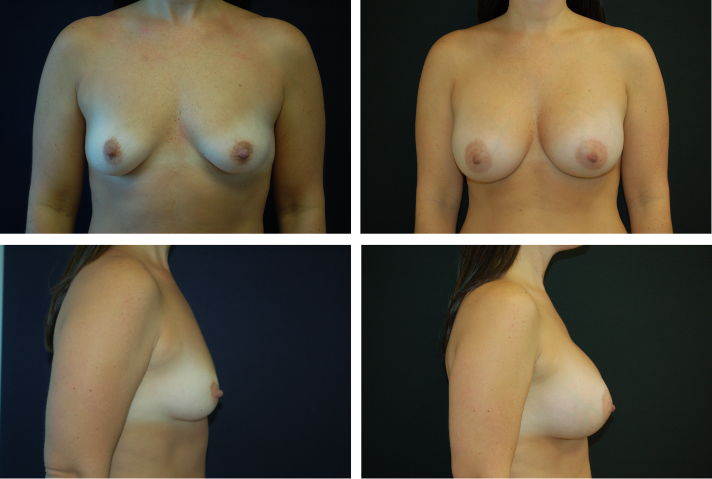 Breast Augmentation Silicone Case 99130