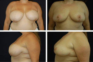 Breast Reduction Case 98105