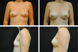 Breast Augmentation Case 99134