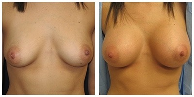 Robinson Breast Augmentation Case 4