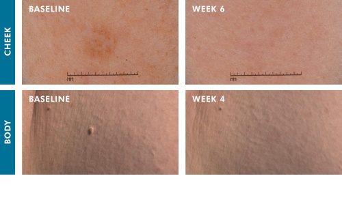CryoCorrect-Body-Visible-Results-SkinCeuticals-2