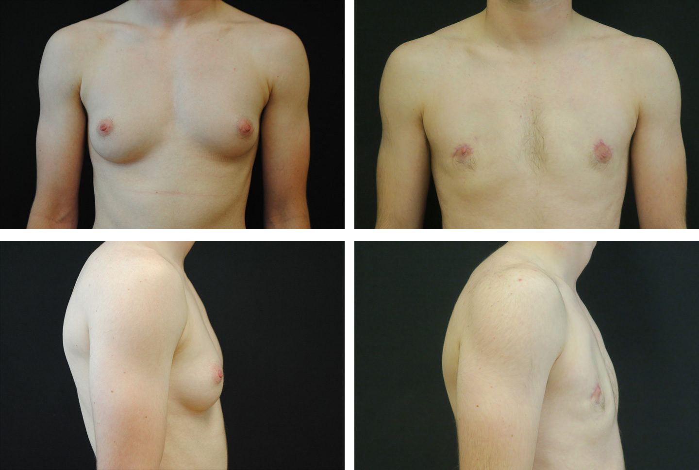 Transgender Female to Male Chest Surgery - Case 01903 - The Plastic Surgery  Group