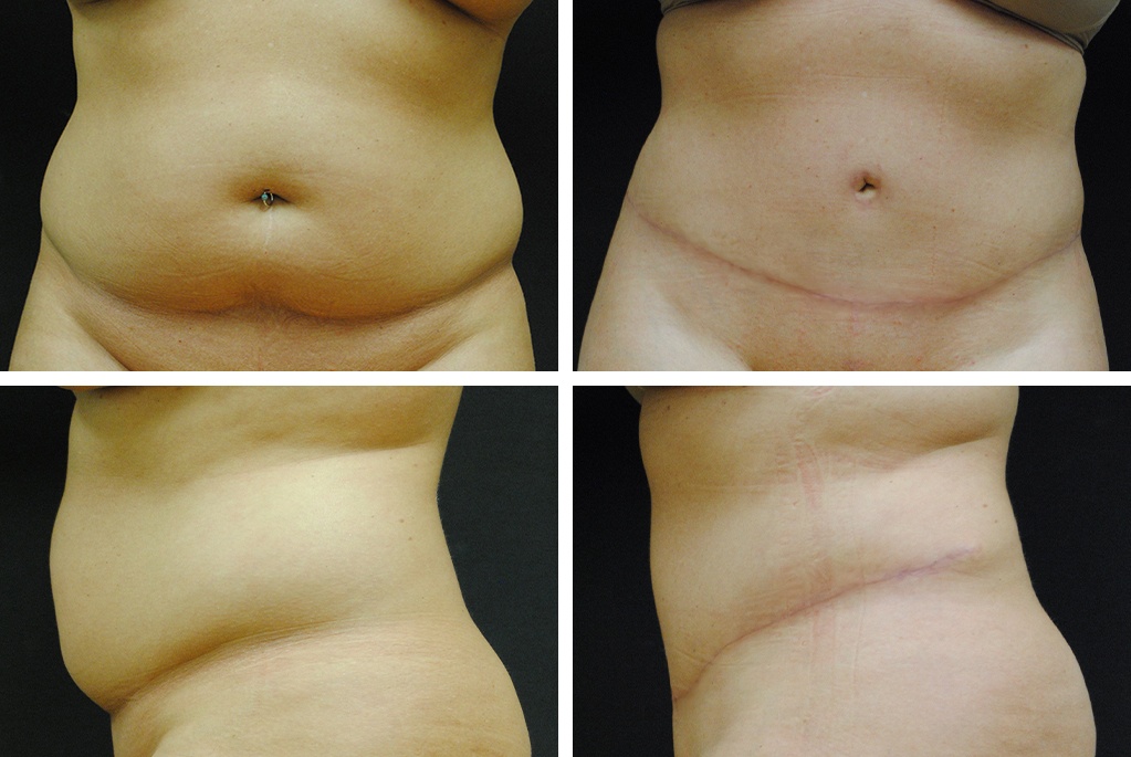 9741-tpsg_nov21-Before_After-abdominoplasty-81413