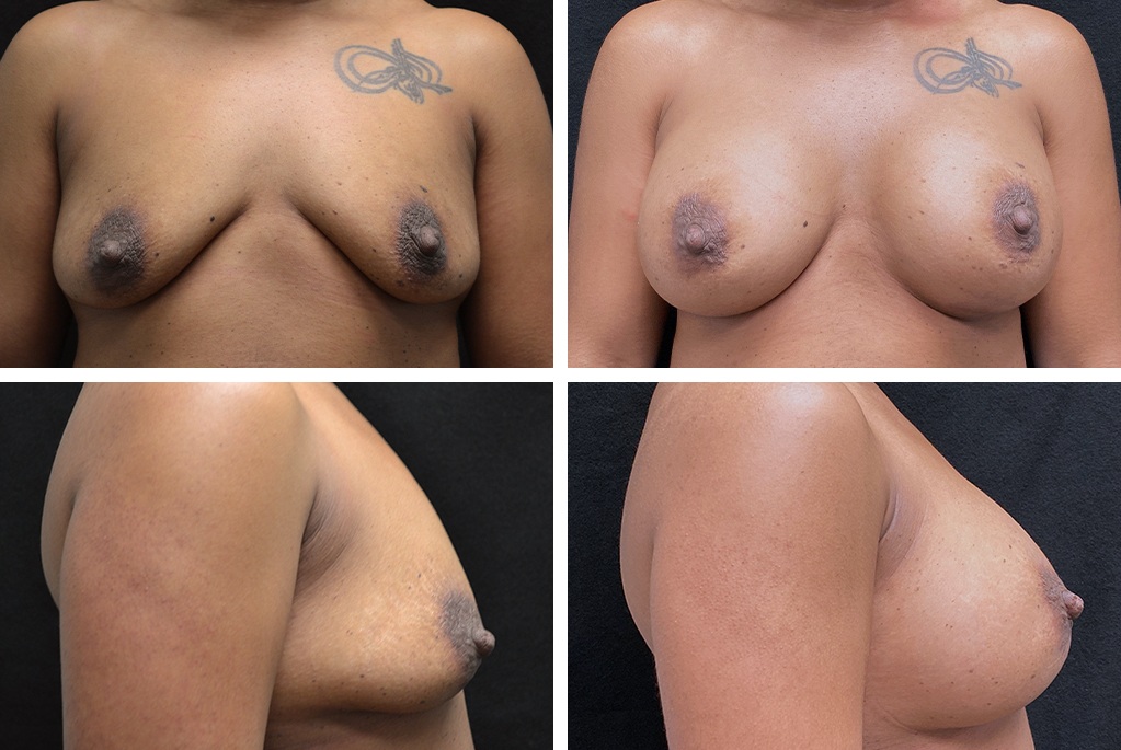 18718-tpsg_nov21-Before_After-breast_aug-14873