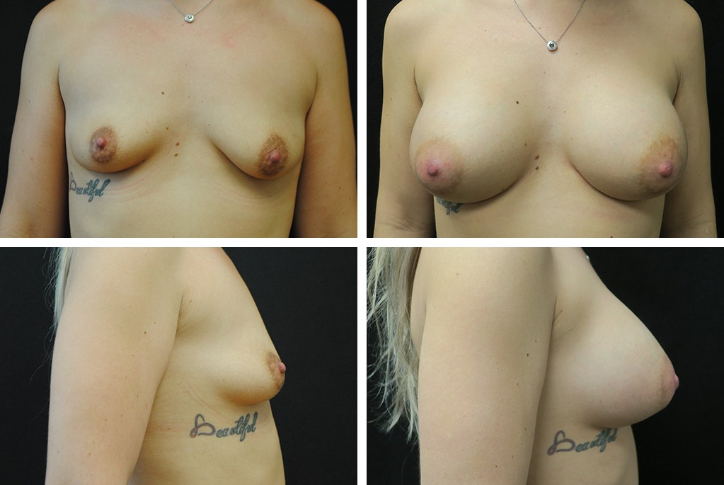 18722-tpsg_nov21-Before_After-breast_aug-69763