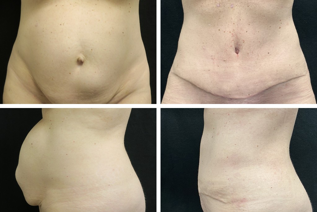 18724-tpsg_nov21-Before_After-abdominoplasty-49473