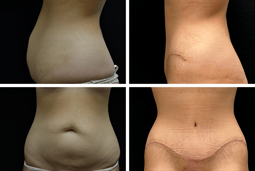pt02402 liposuction tummy tuck