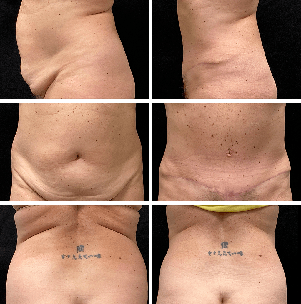 pt 88372 abdominoplasty and lipo of flanks
