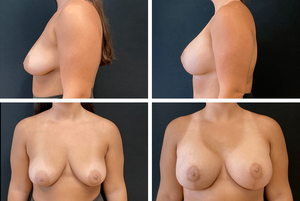 pt68304 bilateral breast augmentation